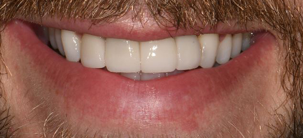 Dental Crowns After