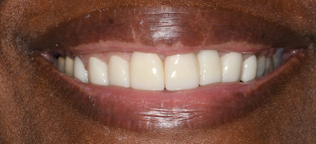 Dental Crowns After