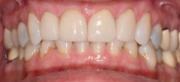 Dental Crowns After