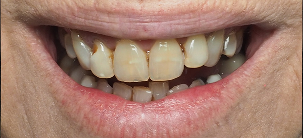 Dental Crowns Before