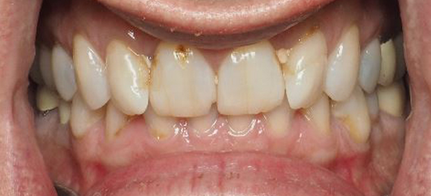 Dental Crowns Before