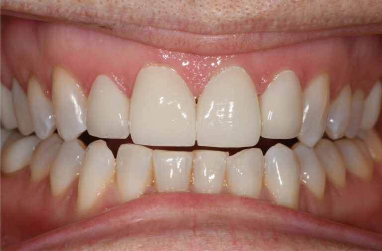 Dental Veneers After