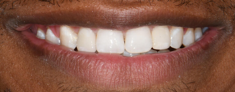 Dental Veneers After