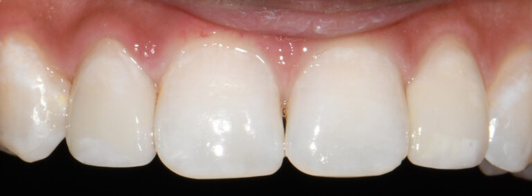 Dental Veneers After