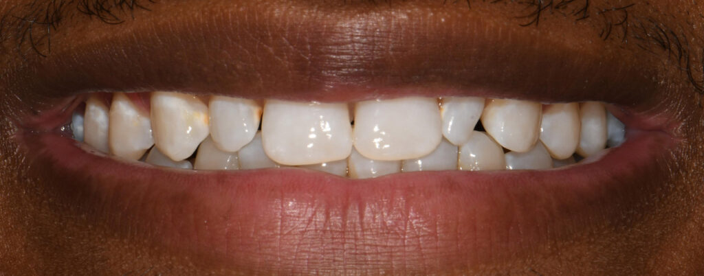 Dental Veneers Before