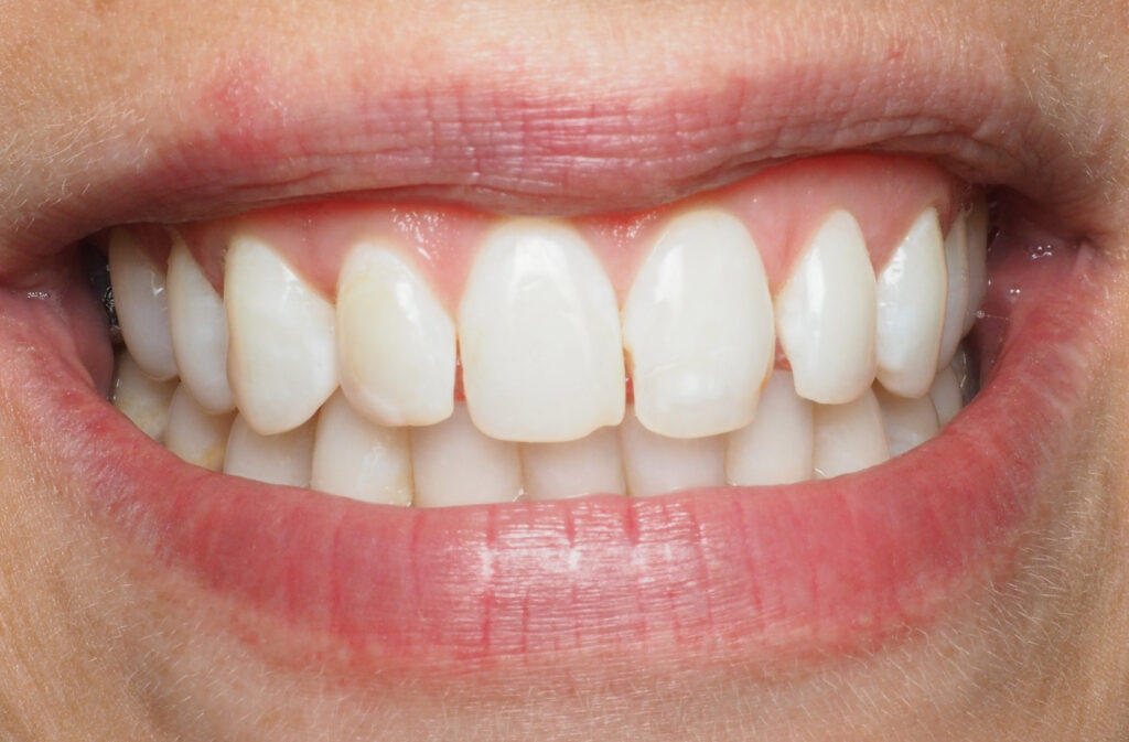 Dental Veneers Before