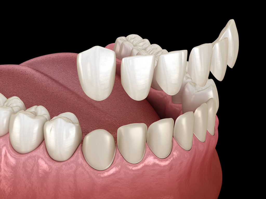 illustration of dental veneers application to the bottom row of teeth