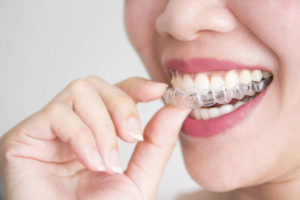 a person placing invisalign clear aligners on their teeth