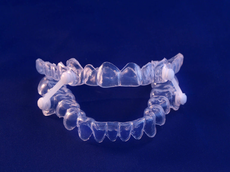 Pair of transparent dental aligners connected by white elastic bands, molded to fit over teeth. Set against a dark blue background, the image highlights orthodontic devices used for alignment or jaw positioning.
