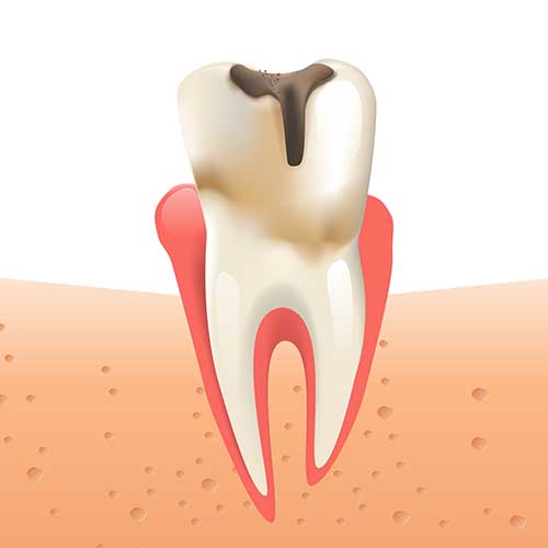 illustration of a tooth with decay, indicating a cavity is present