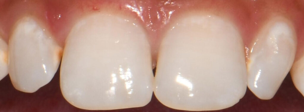 Dental Veneers Before