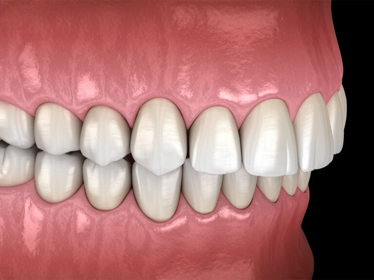 illustration of teeth with an overbite