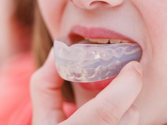 Close-up of person positioning clear dental aligner over upper teeth, transparent device fitting snugly for orthodontic treatment.