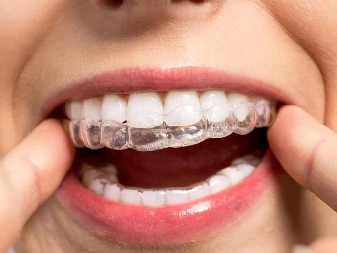 ClearCorrect Clear Aligners near Chattanooga, TN at River Valley Dentistry