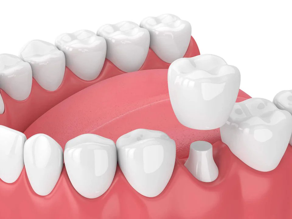 Dental Crowns & Bridges near Chattanooga, TN at River Valley Dentistry