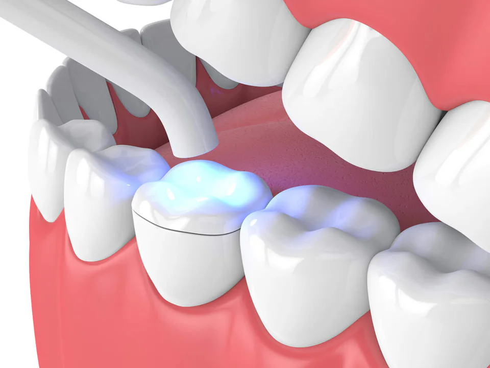 Dental Inlays & Onlays near Chattanooga, TN at River Valley Dentistry