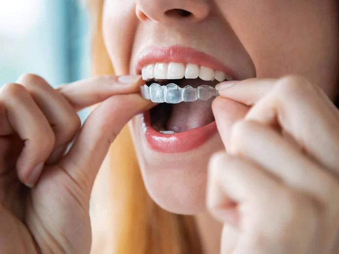 Invisalign near Chattanooga, TN at River Valley Dentistry