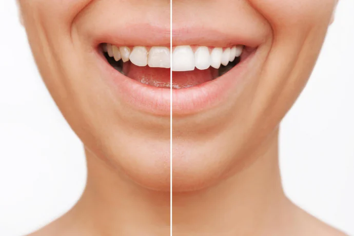 SmileViz Digital Dental Makeovers at River Valley Dentistry