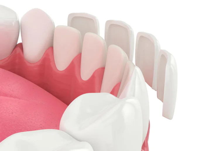 Dental Veneers near Chattanooga, TN at River Valley Dentistry